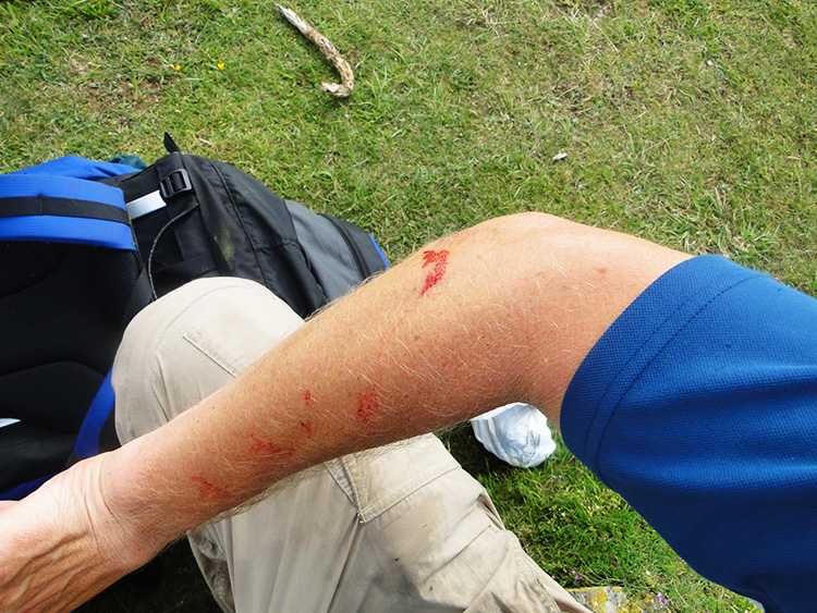 The bloody arm